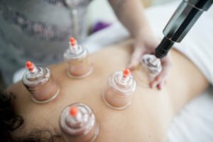 cupping-therapy-300x200 - Hope Wellness